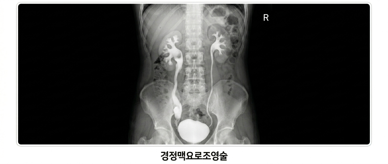경정맥요로조영술 IVP