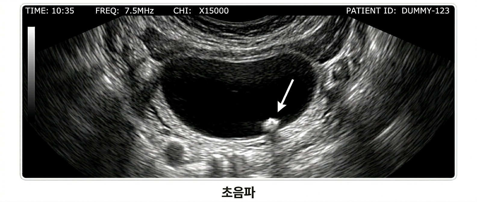 초음파 검사